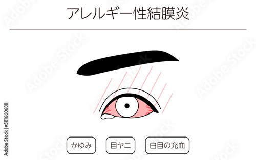 医療イラスト、眼病・アレルギー性結膜炎の線画イラスト