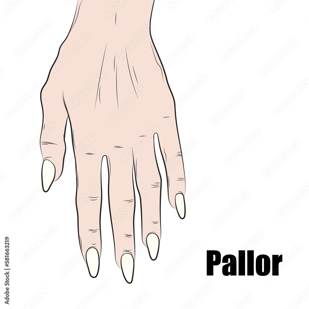 Paleness Can Be Caused By Anemia blood Loss Poor Nutrition Or the-importance-of-nutrition-and-brain-development-brain-workshop