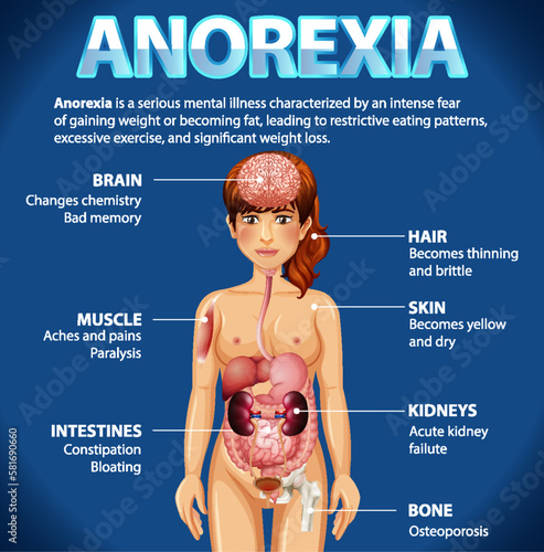 Informative poster of Anorexia eating disorder