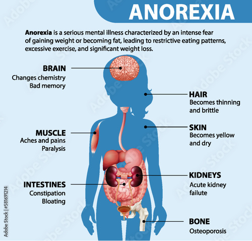 Informative poster of Anorexia eating disorder