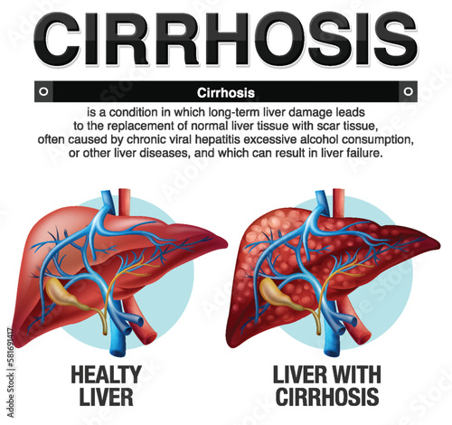 Cirrhosis of the Liver Infographic photo