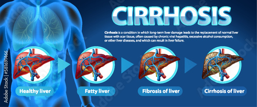 Informative poster of alcoholic liver disease Cirrhosis
