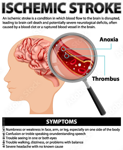 Informative poster of Ischemic stroke