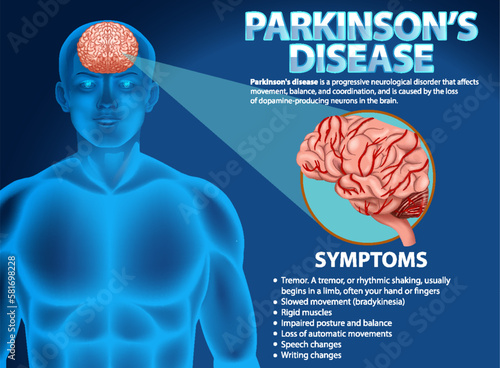Informative poster of Parkinson disease