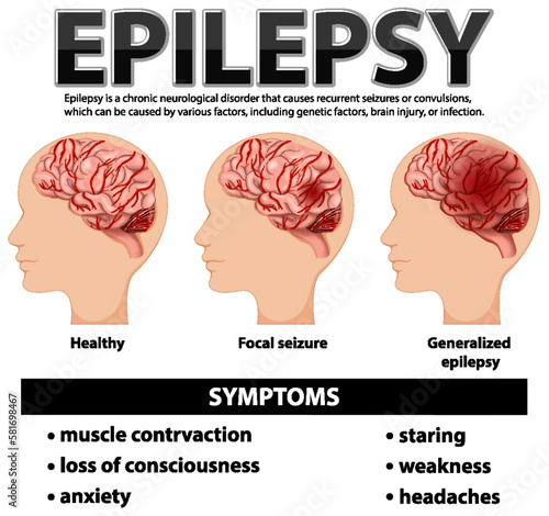 Informative poster of Epilepsy