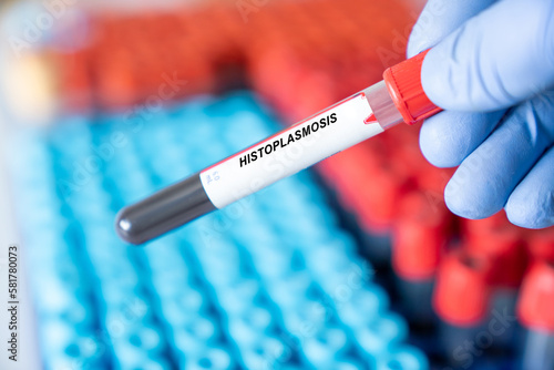 Histoplasmosis. Histoplasmosis disease blood test inmedical laboratory photo