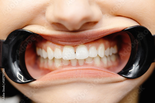 Fotografie Close up of woman cavity protected by retractor showing perfect teeth