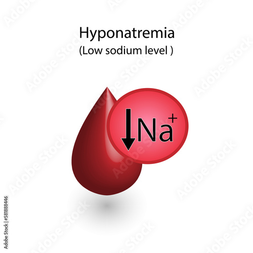 Hyponatremia, low plasma sodium level. Sodium Na excess and deficit electrolyte disorders, blood test tube, Scientific design. Vector illustration.