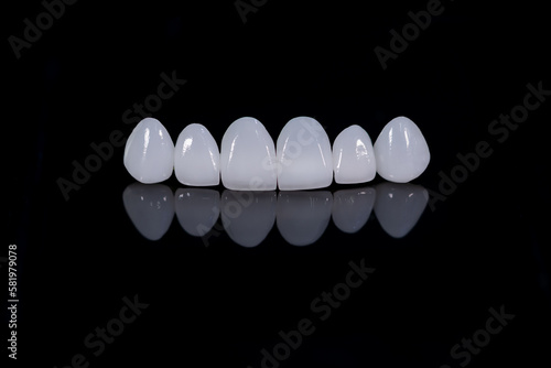 Porcelain dental veneers photo