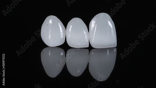 Porcelain dental veneers