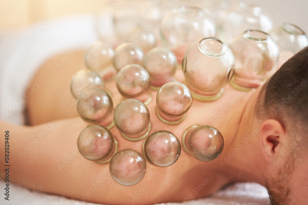 A picture of a man having cupping therapy A picture of a man having cupping therapy