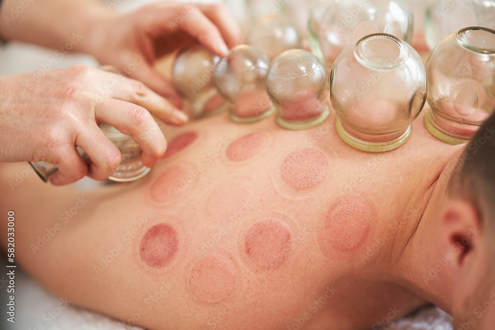 A picture of a man having cupping therapy A picture of a man having cupping therapy