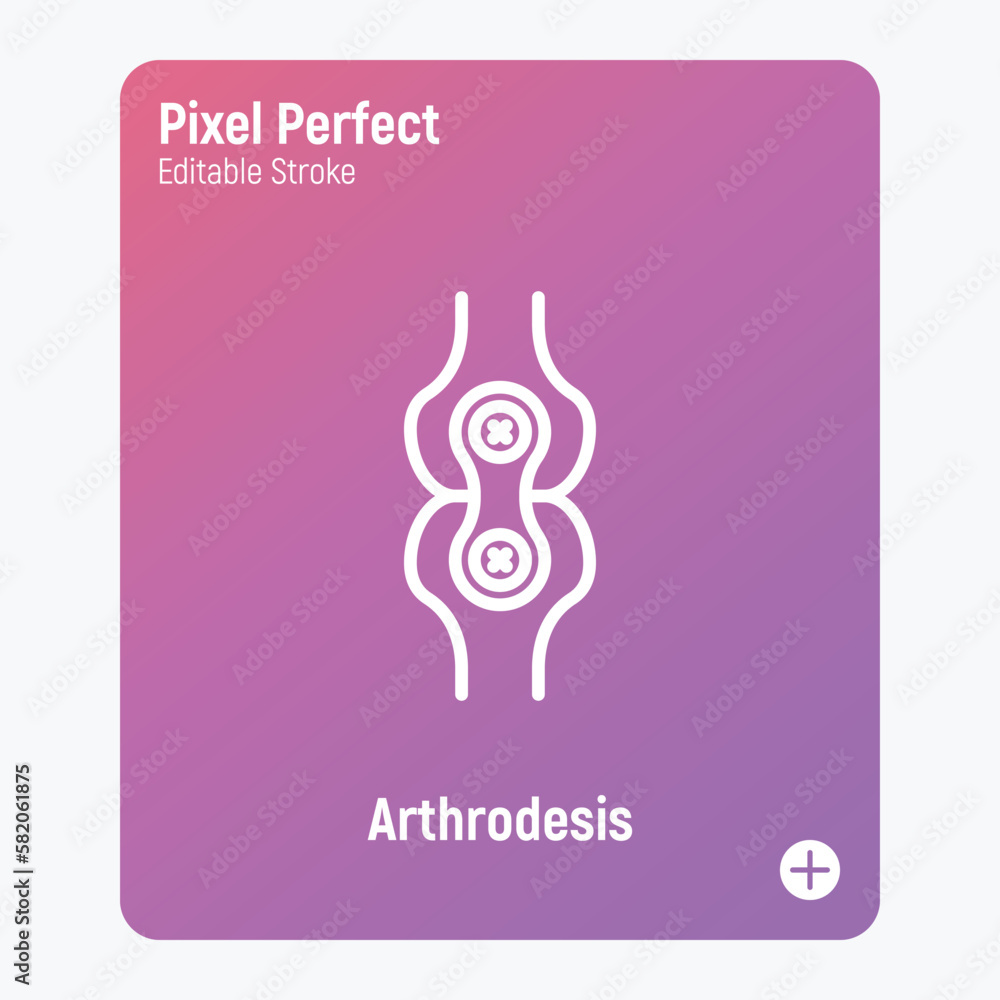 Arthrodesis joint surgery thin line icon. Arthritis. Pixel perfect, editable stroke. Vector illustration.