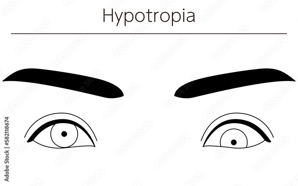 Medical illustrations, diagrammatic line drawings of eye diseases, strabismus and hypotropia Medical illustrations, diagrammatic line drawings of eye diseases, strabismus and hypotropia