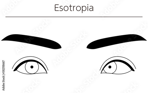 Medical illustrations, diagrammatic line drawings of eye diseases, strabismus and esotropia photo