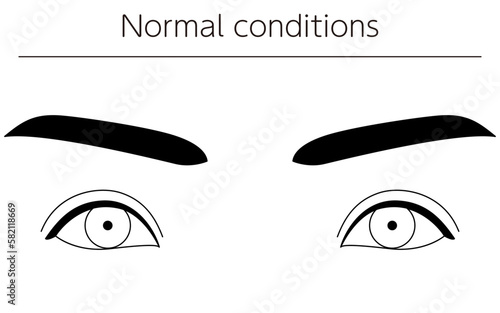 Medical illustrations, diagrammatic line drawings of eye diseases, strabismus and normal conditions
