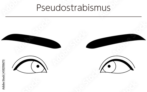 Medical illustrations, diagrammatic line drawings of eye diseases, strabismus and pseudostrabismus
