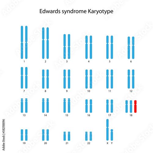 Edwards syndrome (trisomy 18) human (male) karyotype