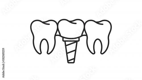 Animated prosthesis linear icon. Endosseous implant. Dental surgery. Tooth replacement. Seamless loop HD video with alpha channel on transparent background. Outline motion graphic animation photo