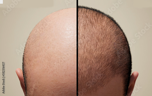 The head of a balding man before and after hair transplant surgery. Man before after hair loss treatment. Head balding man before after hair.  photo