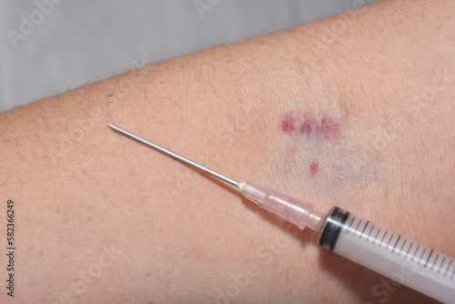 Petechiae from broken blood vessels after blood draw on woman's arm photo