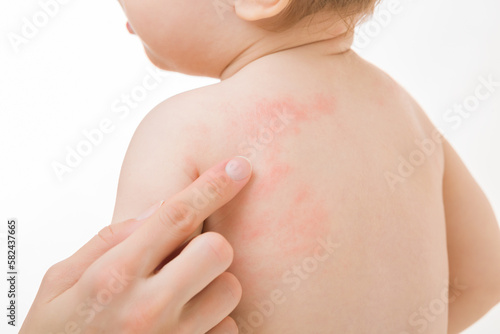 Quadro su tela Young adult mother finger pointing to red rash on infant back