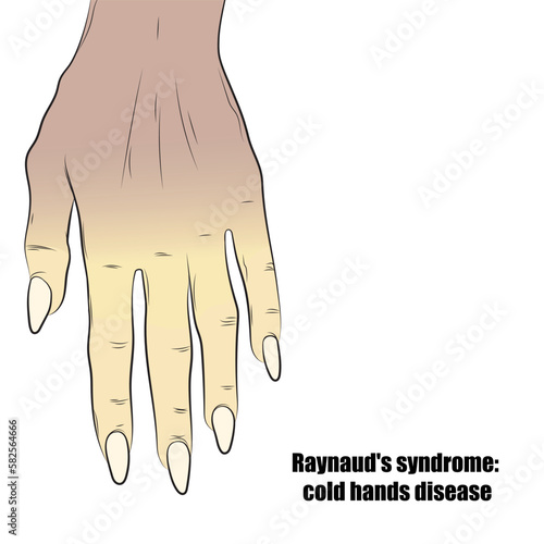 Raynaud's disease causes a feeling of numbness and coldness in some areas of the body, such as the fingers and toes