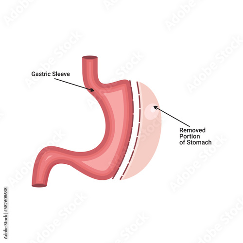 Laparoscopic Sleeve Gastrectomy  simple vector