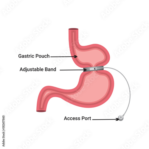 Stomach with adjustable gastric band device. Bariatric surgery weight loss procedure. Stomach reduction anatomical diagram infographic. Health care medical concept. Vector illustration