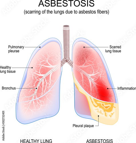 asbestosis lungs. Inflammation and scarring of the lungs