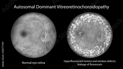 Autosomal dominant vitreoretinochoroidopathy, illustration showing normal eye retina and retina with hyperfluorescent lesions and leakage of lipofuscin photo