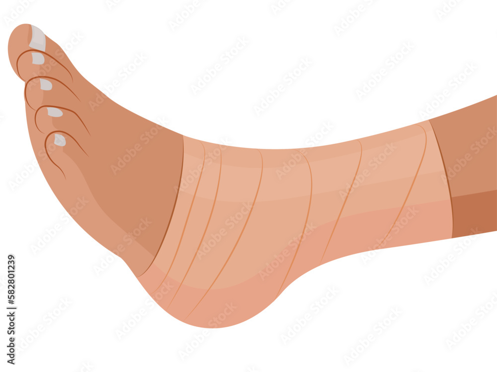 Fractured Leg, foot with a bandage, Bandaged human body parts vector illustration Fractured Leg, foot with a bandage, Bandaged human body parts vector illustration