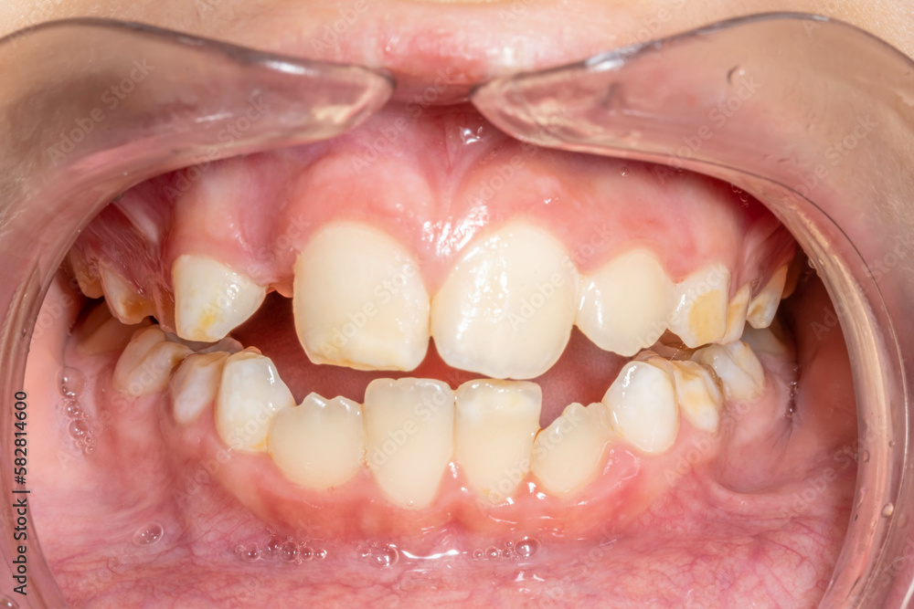 Front view of a young boy's dental arches separated, lips and cheeks retracted. Unhealthy teeth with barely visible white yellowish color decayed spots in the teeth surface.