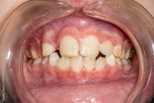 Front view of a young boy's dental arches in occlusion, lips and cheeks retracted. Unhealthy teeth with barely visible white yellowish color decayed spots in the teeth surface.