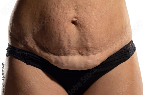 Woman with loose skin and stretch marks on her belly after pregnancy
