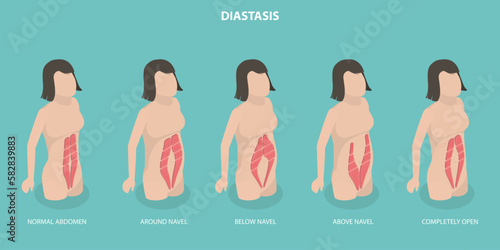 3D Isometric Flat Vector Conceptual Illustration of Abdominal Muscle Diastasis, Women Probmlem After Pregnancy