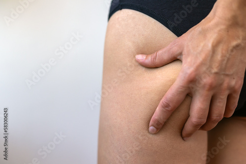 Female body with stretch marks on the buttocks