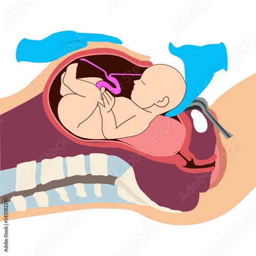 Baby removal during childbirth through caesarean section. Fetus movement during the c-section. Biology and gynecology
