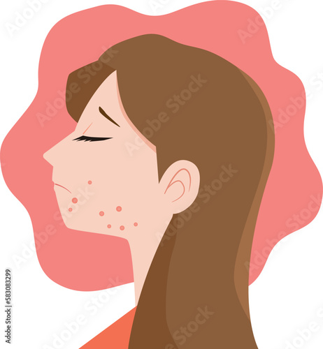 ニキビ肌荒れに悩む女性