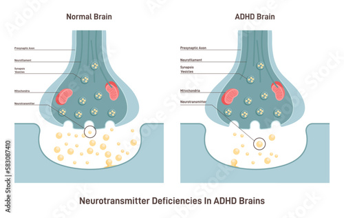 ADHD brain concept. Attention deficit hyperactivity disorder, neurotransmitters