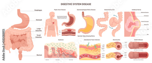 Digestive system diseases set. Gastroenterology disorder, internal