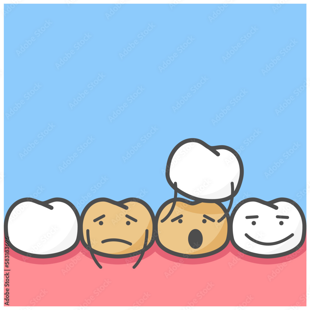 Smile makeover, dental ceramic veneers, row of cute cartoon teeth covering with veneers, vector Smile makeover, dental ceramic veneers, row of cute cartoon teeth covering with veneers, vector