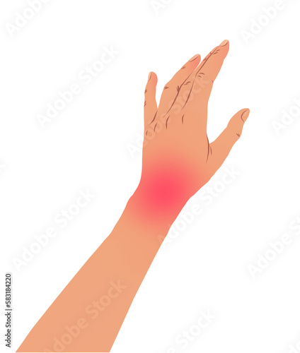 Vector illustration of left hand with carpal tunnel syndrome