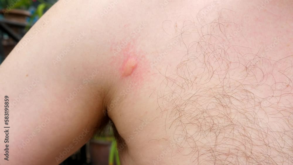 Close-up of man chest showing visible insect bites, irritated skin. Concept of allergies by mosquito bites. Repellent, dengue virus, yellow fever, West Nile, and malaria spread by mosquitoes Close-up of man chest showing visible insect bites, irritated skin. Concept of allergies by mosquito bites. Repellent, dengue virus, yellow fever, West Nile, and malaria spread by mosquitoes