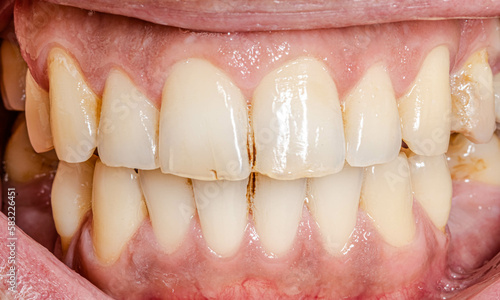 Front view of dental arches in occlusion, lips and cheeks retracted. Unhealthy teeth with barely visible micro cracks and a blackish brown color in proximal areas extrinsic staining like black stain.