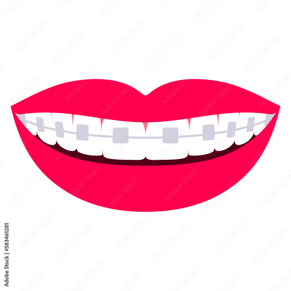 Orthodontic braces on teeth. Smile. Illustration on transparent background Orthodontic braces on teeth. Smile. Illustration on transparent background