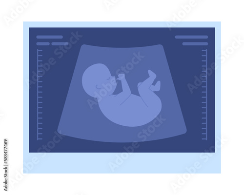 Fetal ultrasound picture semi flat color vector object. Pregnancy progress. Editable icon. Full sized element on white. Simple cartoon style spot illustration for web graphic design and animation