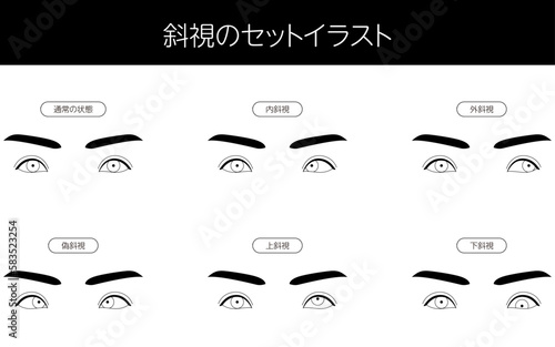 医療イラスト、眼病・斜視の図解セットイラスト