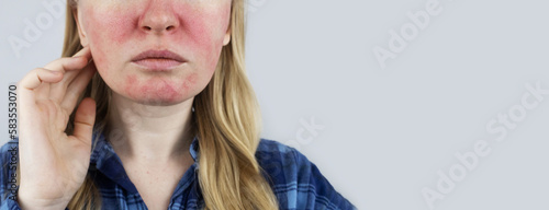 Rosacea face. The girl suffers from redness on her cheeks. Couperosis of the skin. Redness and capillary mesh are visible on the face. Treatment and removal. Vascular surgery and dermatology photo