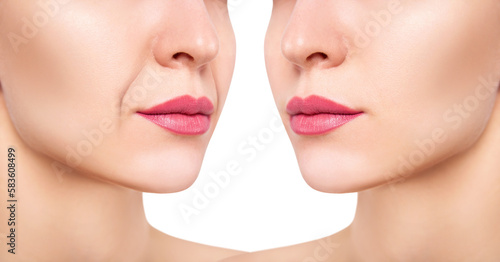 Chin of beautiful woman before and after rejuvenation.